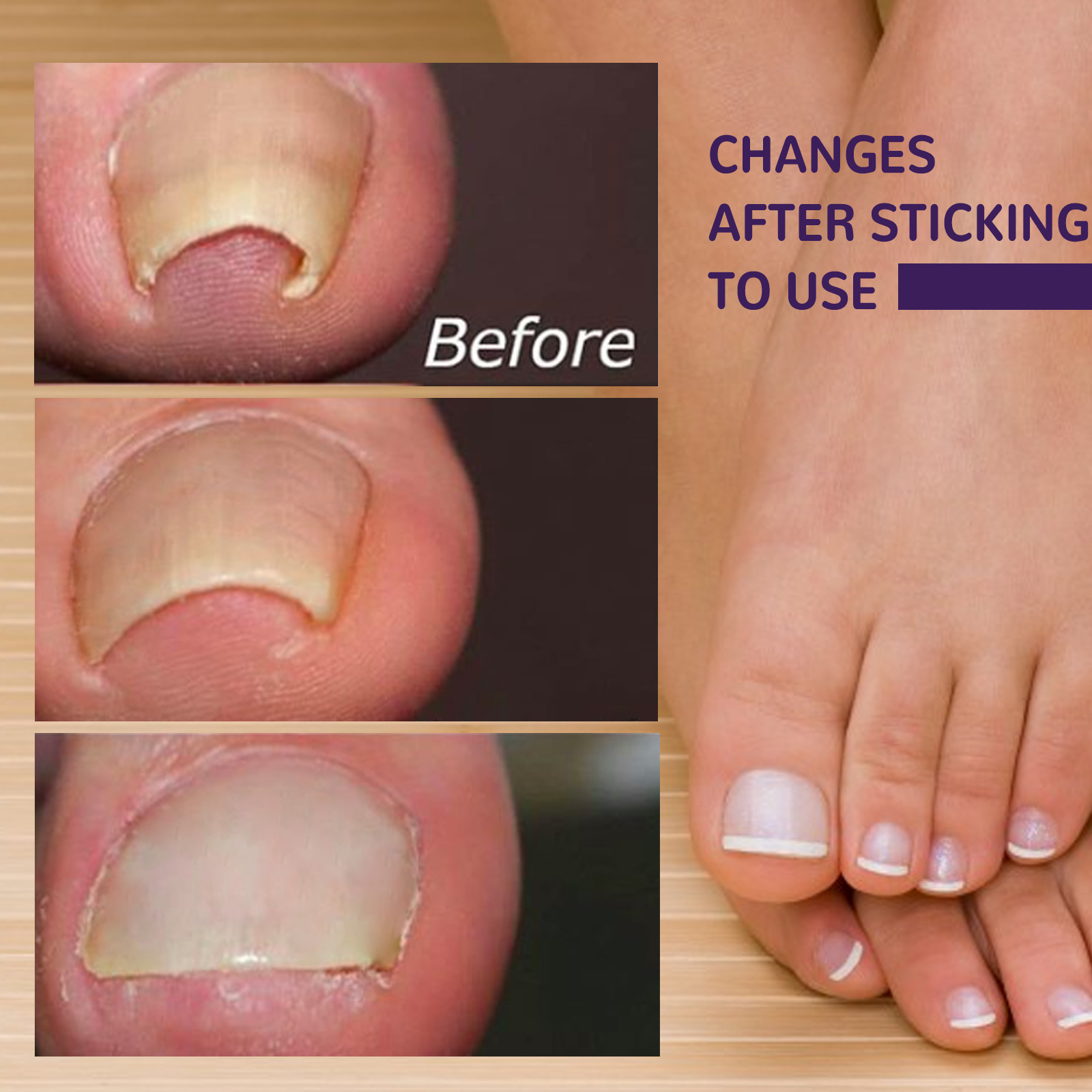 Elastic Toenail Correction Patch, Nail Groove Correction Nail Repair Ingrown Nail Patch - Afbeelding 5